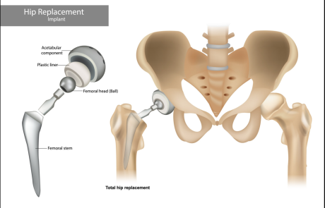 זקוקים להחלפת מפרק? כך תבחרו אורטופד מומחה ברכיים וירך