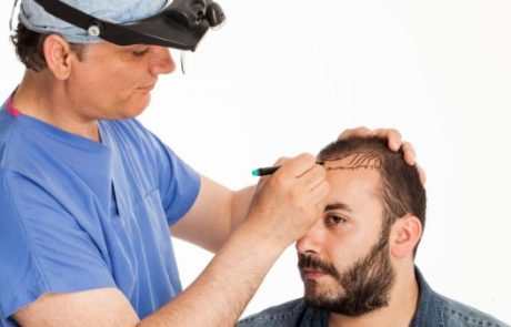 כל מה שצריך לדעת על השתלות שיער לגברים